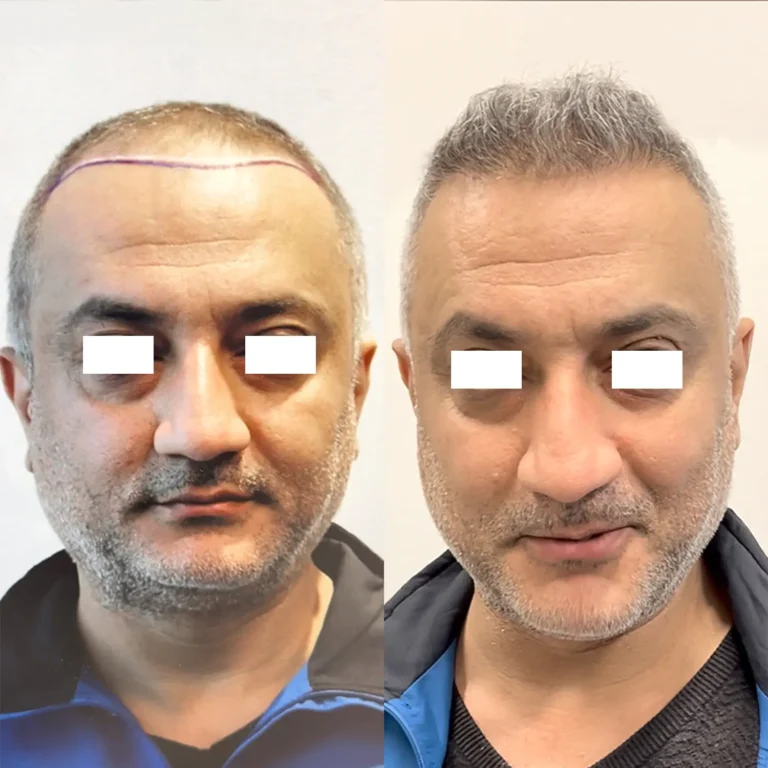 Saç ekimi öncesi ve sonrası sonucu 1